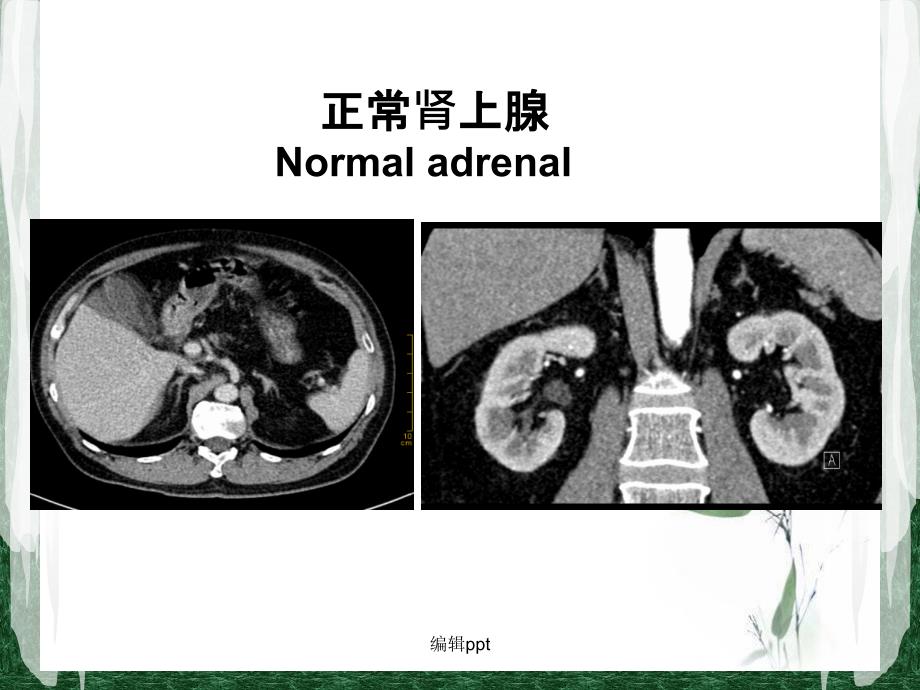 肾上腺静脉分段取血在原发性醛固酮增多症中的应用课件_第2页