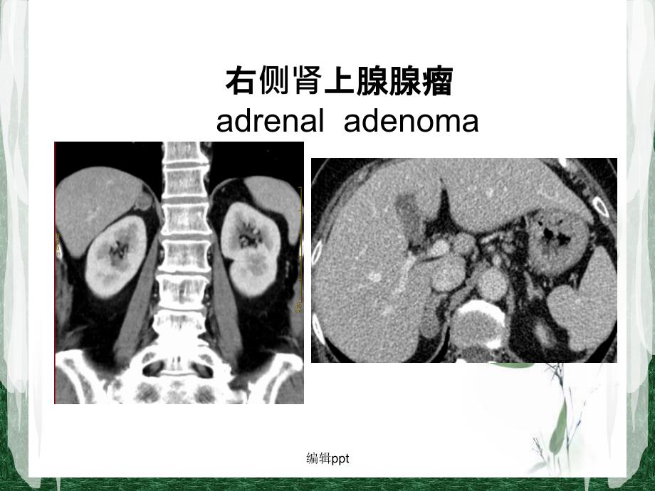 肾上腺静脉分段取血在原发性醛固酮增多症中的应用课件_第3页