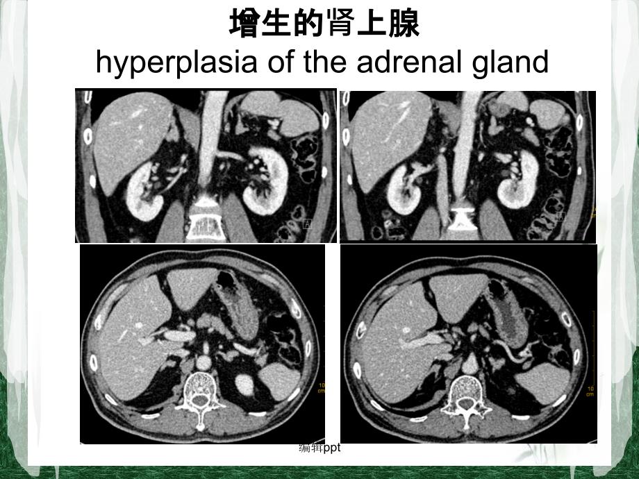 肾上腺静脉分段取血在原发性醛固酮增多症中的应用课件_第4页