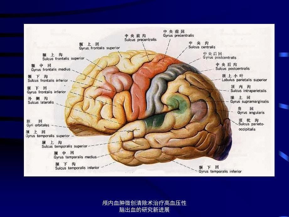 颅内血肿微创清除术治疗高血压性脑出血的研究新进展课件_第5页