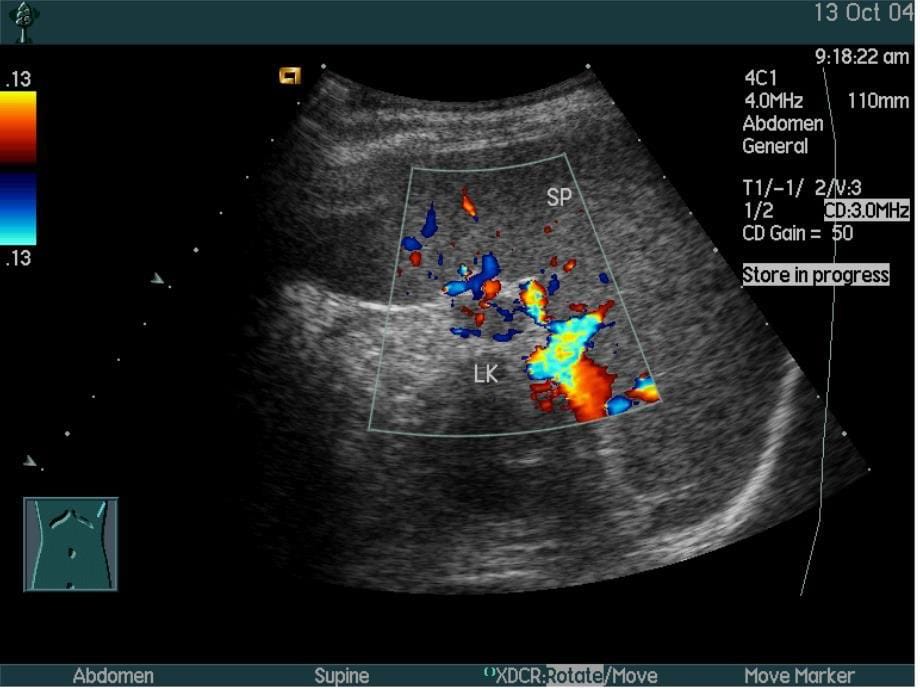 脾脏疾病的超声诊断ppt课件_第5页