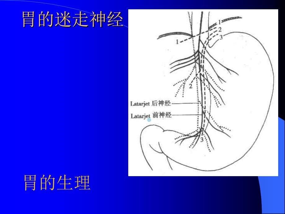 胃十二指肠溃疡的疾病病人的护理课件_第5页