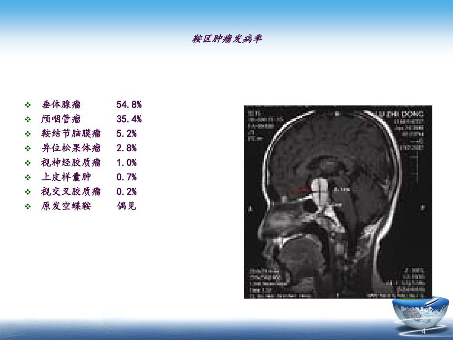 颅咽管瘤目前网上最好的ppt课件_第4页