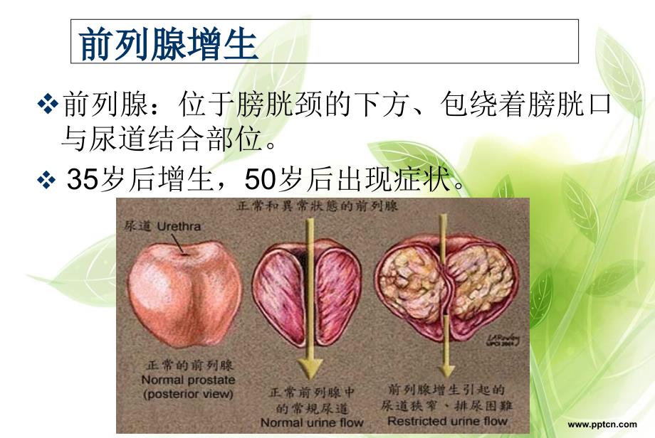 讲义经尿道前列腺电切术_第4页