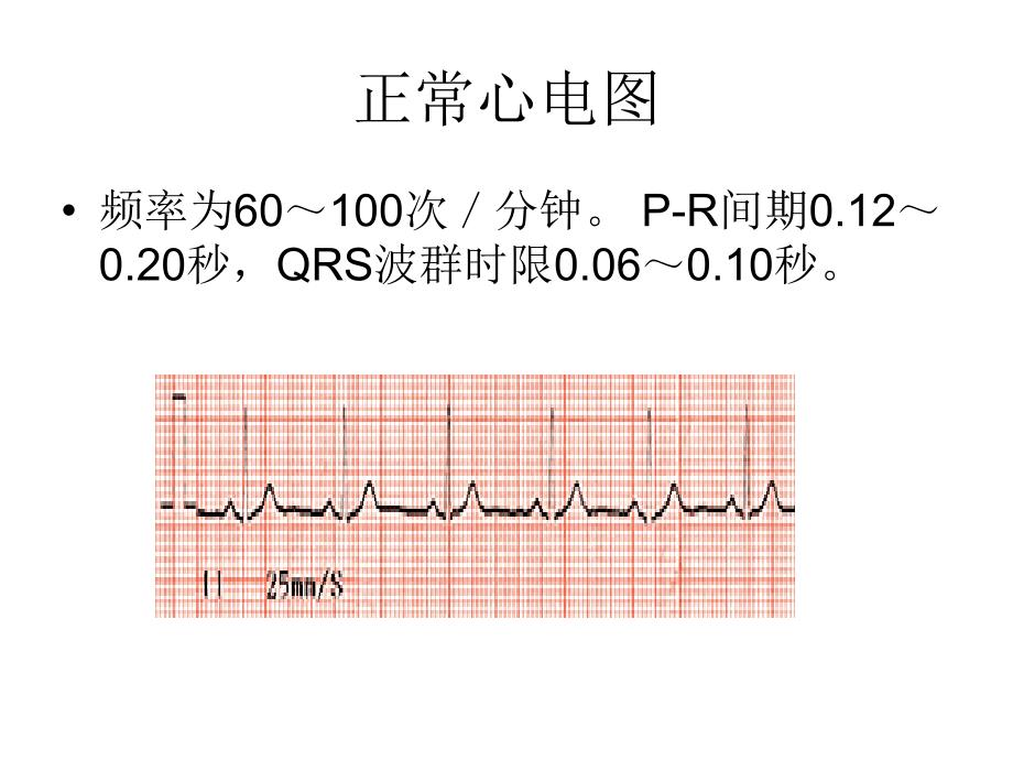 心电监护常见图形PPT课件_第3页