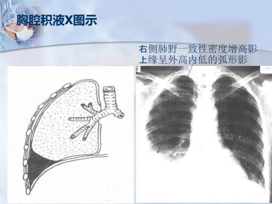 三大穿刺术胸穿腹穿腰穿_第4页