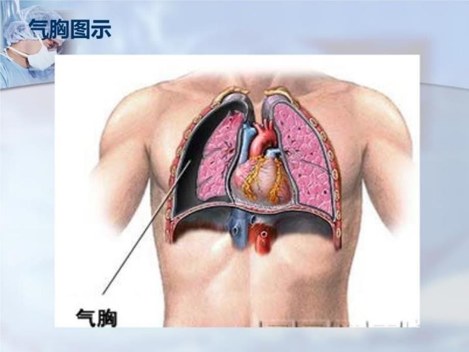 三大穿刺术胸穿腹穿腰穿_第5页