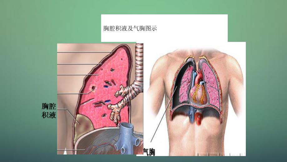 胸腔穿刺技能操作干货分享_第3页