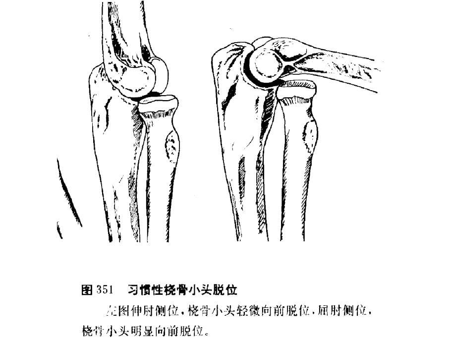 5关节脱位的急救课件_第5页