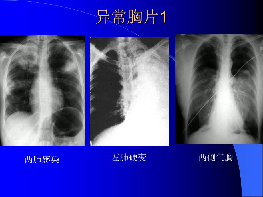 呼吸系统X线CT读片技巧_第2页