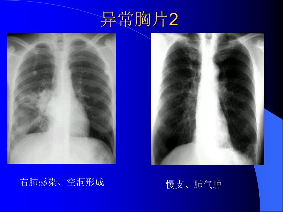 呼吸系统X线CT读片技巧_第3页