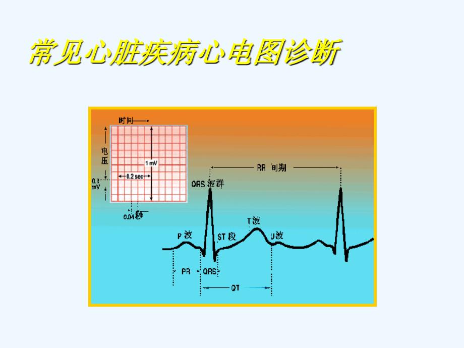 常见心脏疾病心电图诊断_第3页