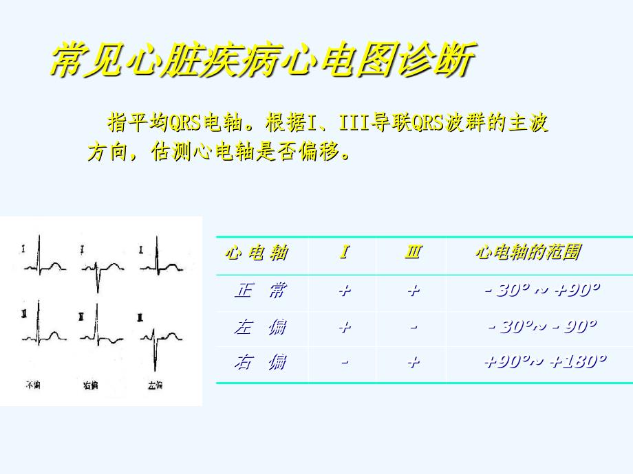 常见心脏疾病心电图诊断_第4页