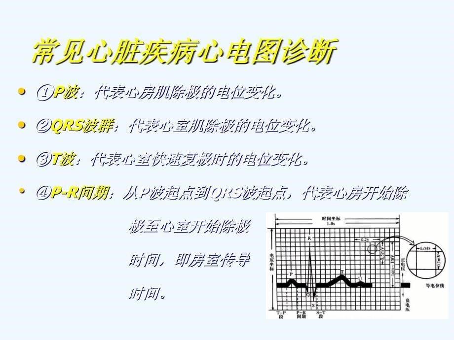 常见心脏疾病心电图诊断_第5页