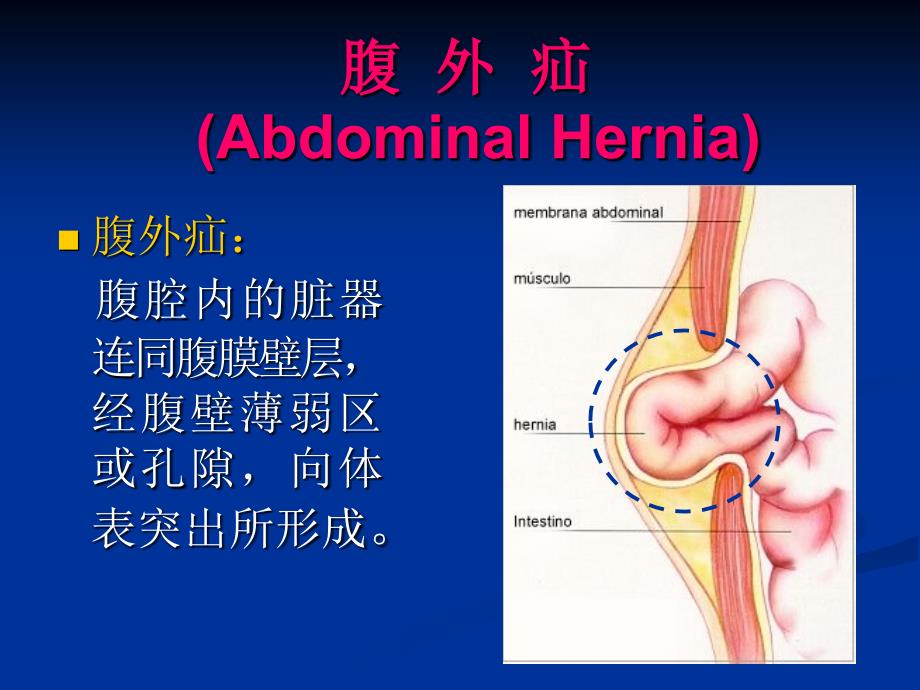 普外腹股沟疝_第4页
