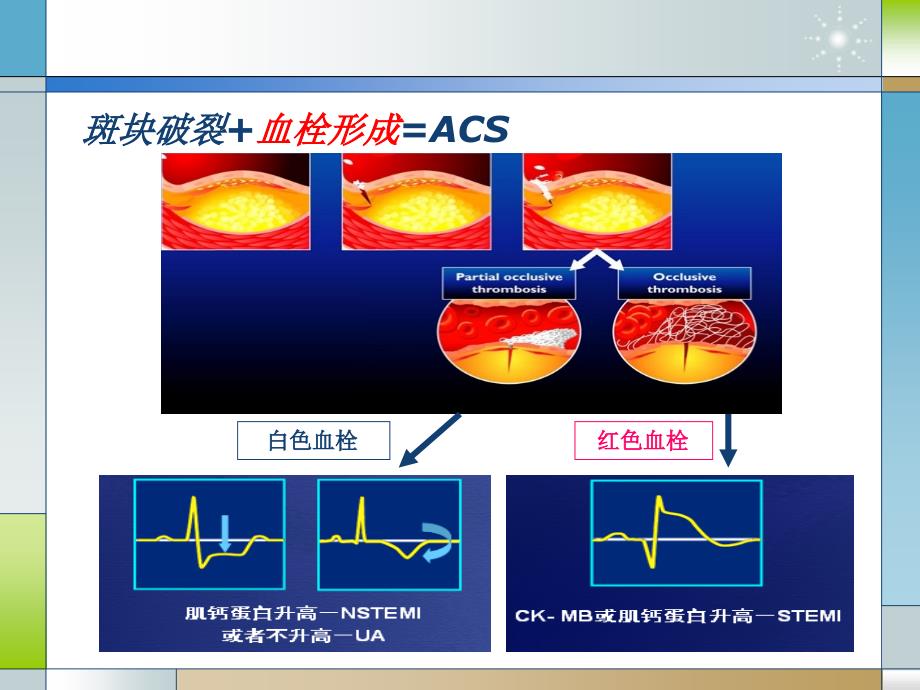 STEMI的再灌注策略_第3页