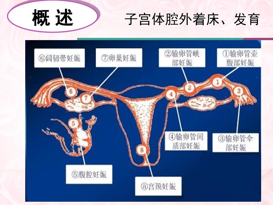 宫外孕失血性休克的护理ppt课件_第3页