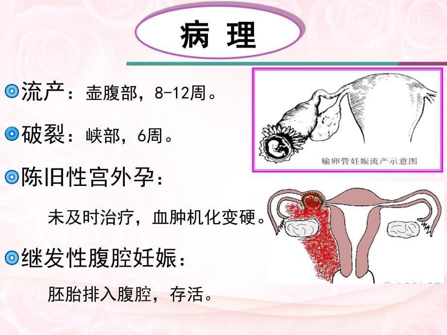 宫外孕失血性休克的护理ppt课件_第5页