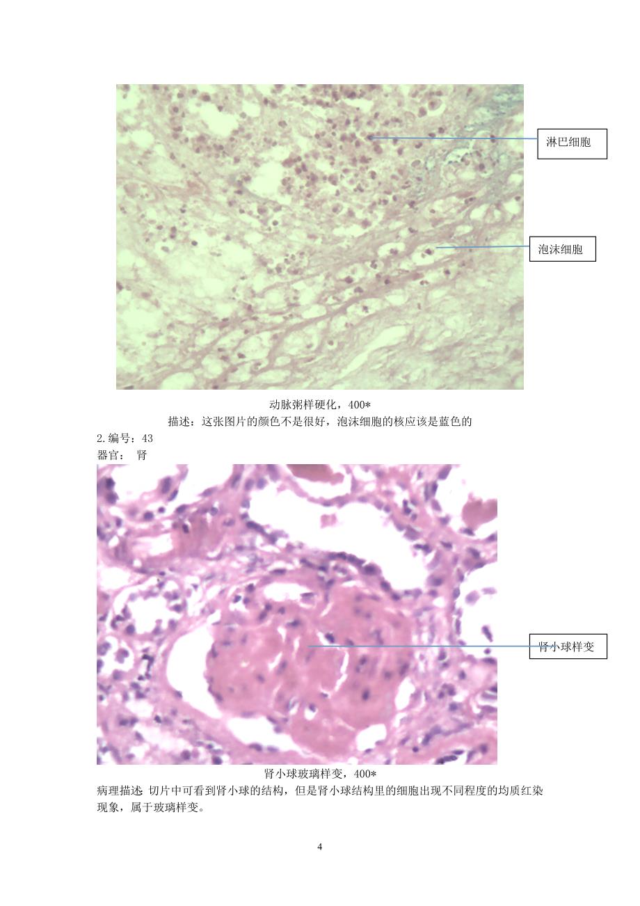 心血管疾病切片与大体观察.doc_第4页