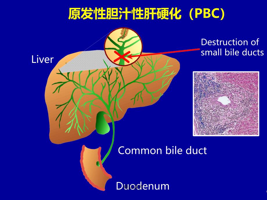 自身免疫性肝病诊治现状课件_第4页