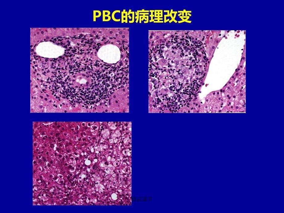 自身免疫性肝病诊治现状课件_第5页