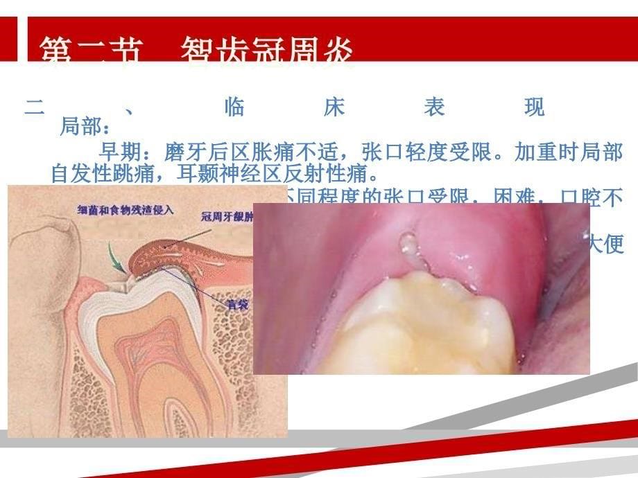 口腔科学第九章口腔颌面部感染课件_第5页