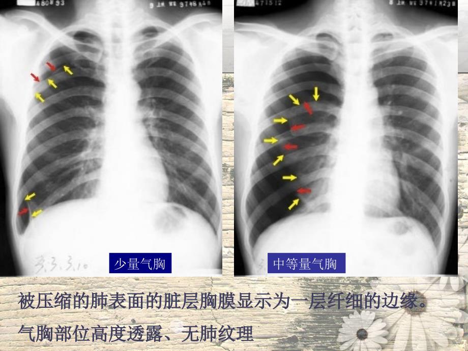 呼吸系统常见疾病影像学表现ppt课件_第3页