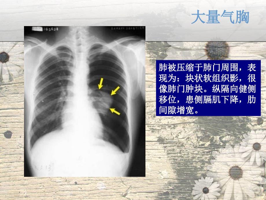 呼吸系统常见疾病影像学表现ppt课件_第4页