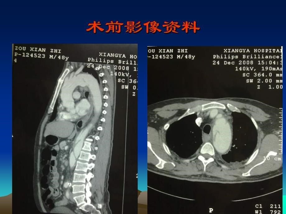 最新病例讨论降主动脉瘤合并真腔闭塞的Ⅲ型主动脉夹层如何处理PPT文档_第5页