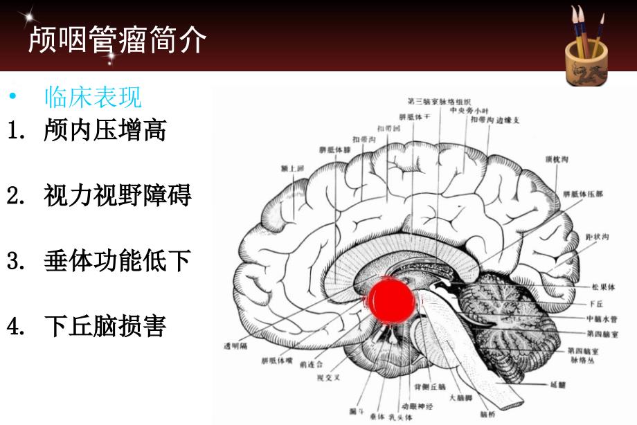 颅咽管瘤护理查房_第4页