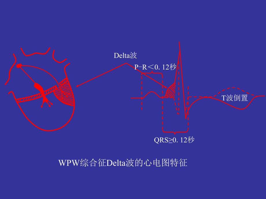 预激综合征的心电图.ppt_第4页