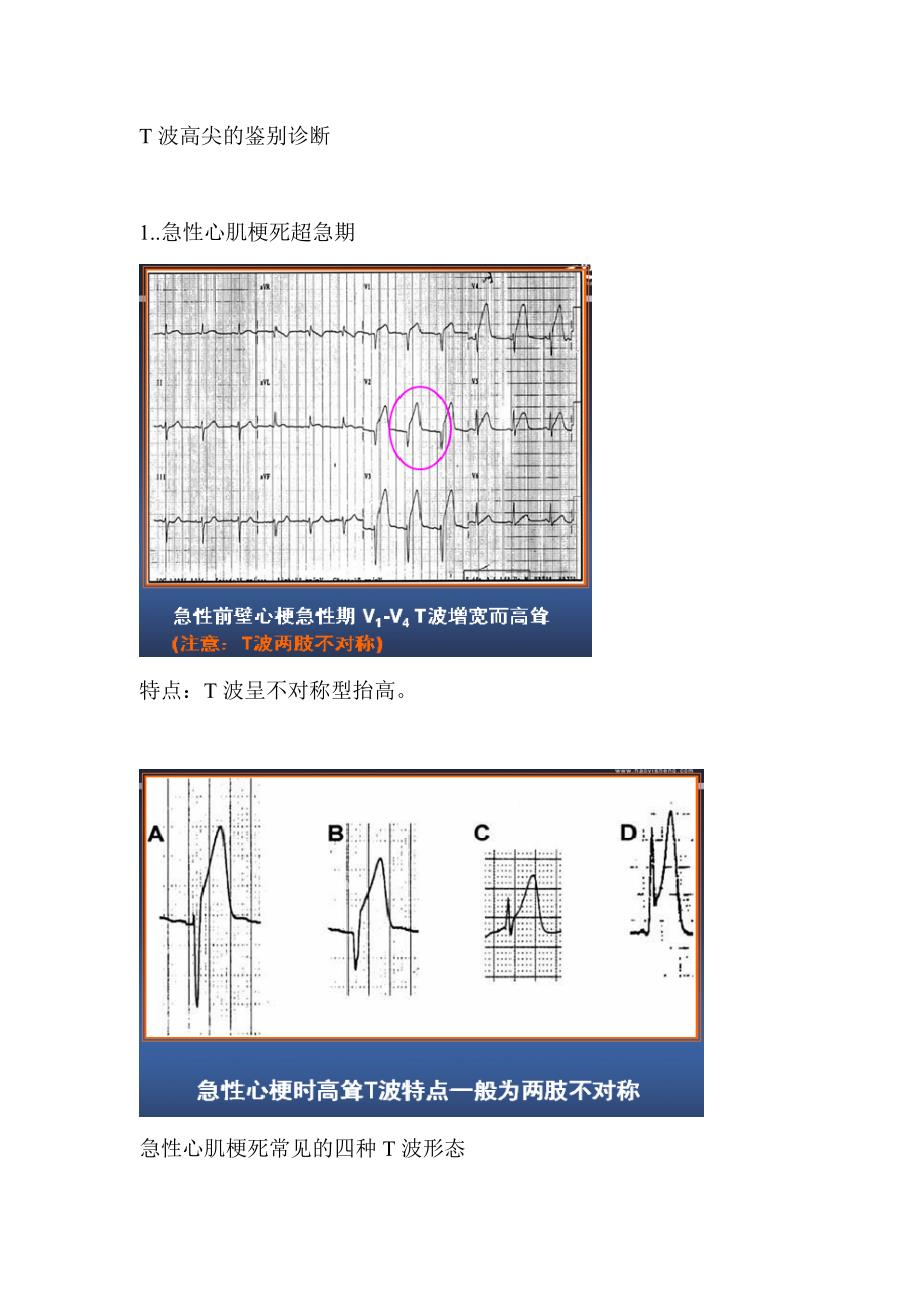 T波高尖的鉴别诊断_第1页