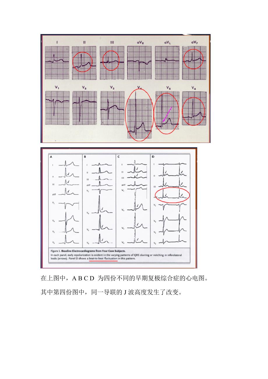 T波高尖的鉴别诊断_第3页