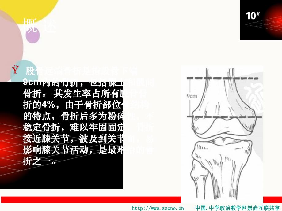 股骨远端骨折46883_第2页