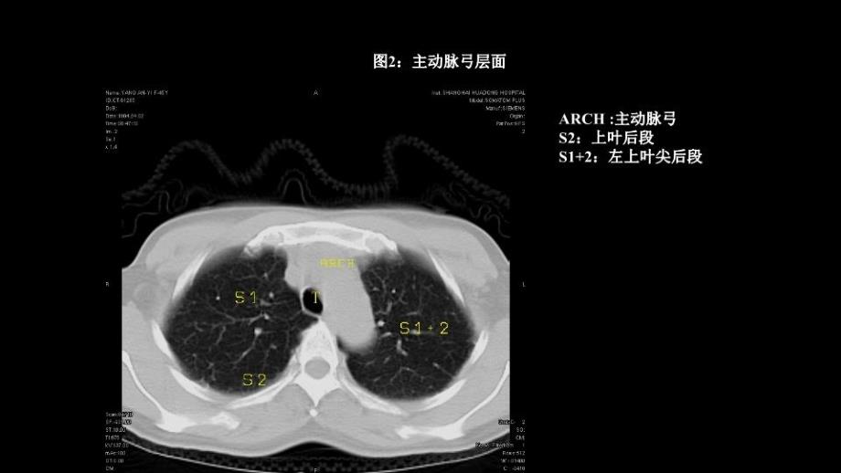 CT肺叶分段及纵膈淋巴结分组_第3页