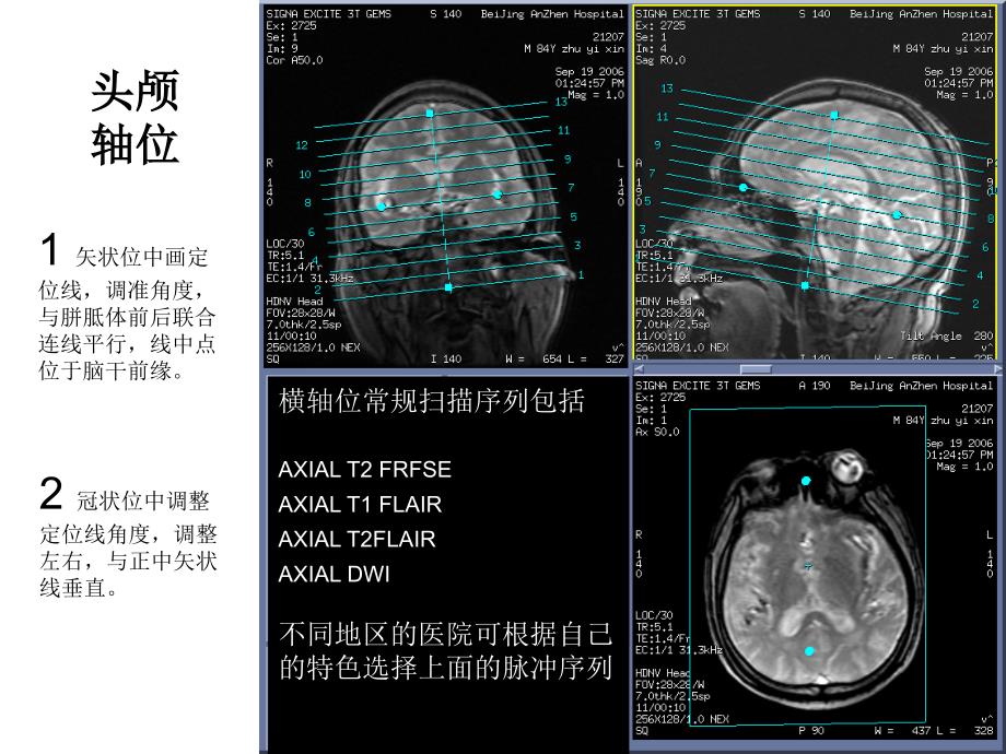 GE15T磁共振操作指南定位线示例神经系统_第2页