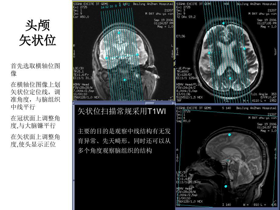 GE15T磁共振操作指南定位线示例神经系统_第3页