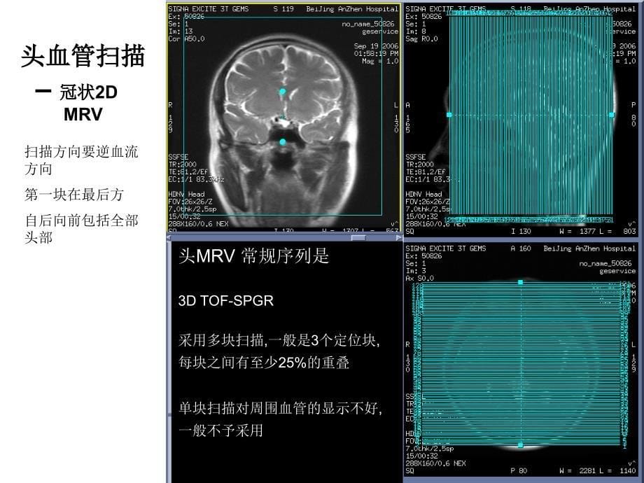 GE15T磁共振操作指南定位线示例神经系统_第5页