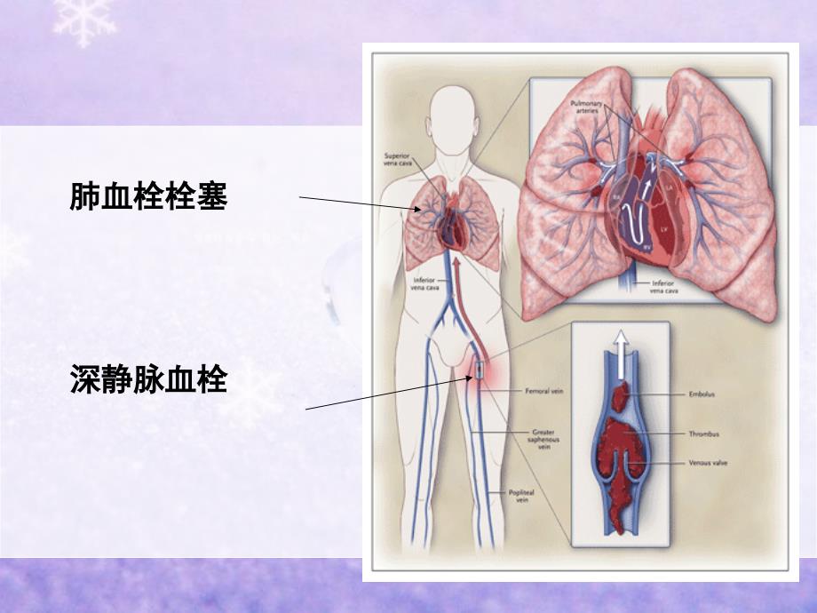 肺栓塞病人的护理课件_第4页