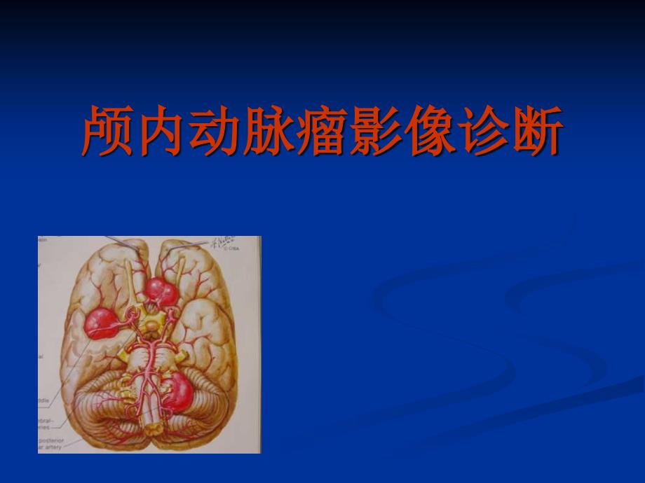 颅内动脉瘤影像诊断.ppt_第1页