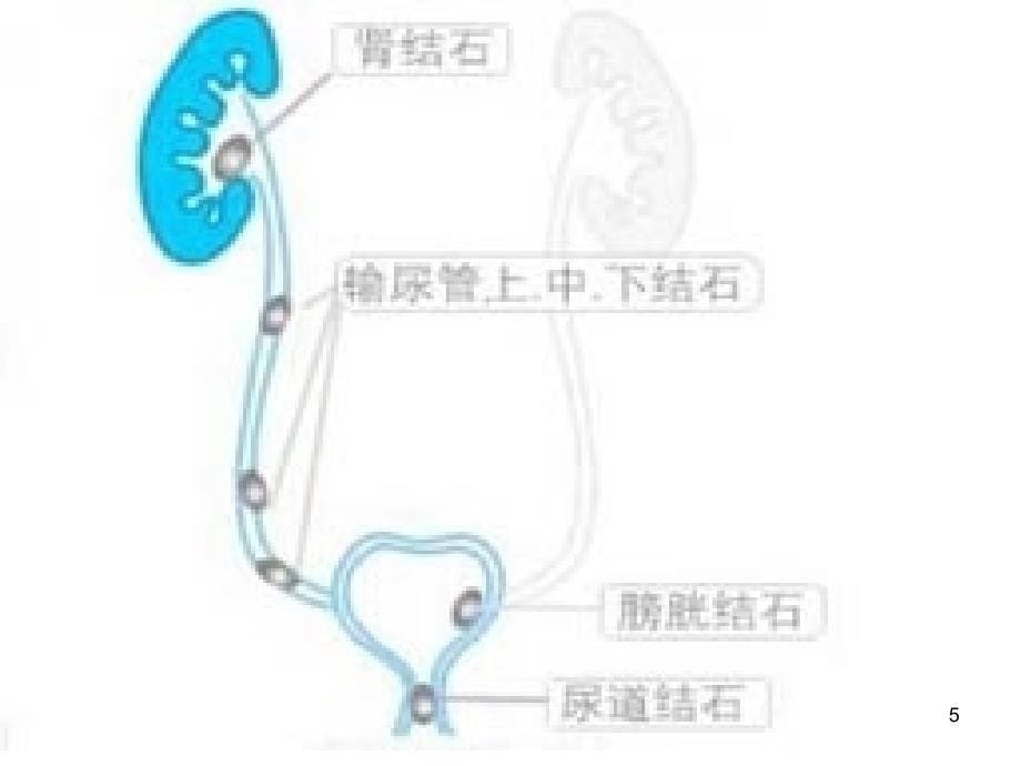 肾输尿管结石_第5页