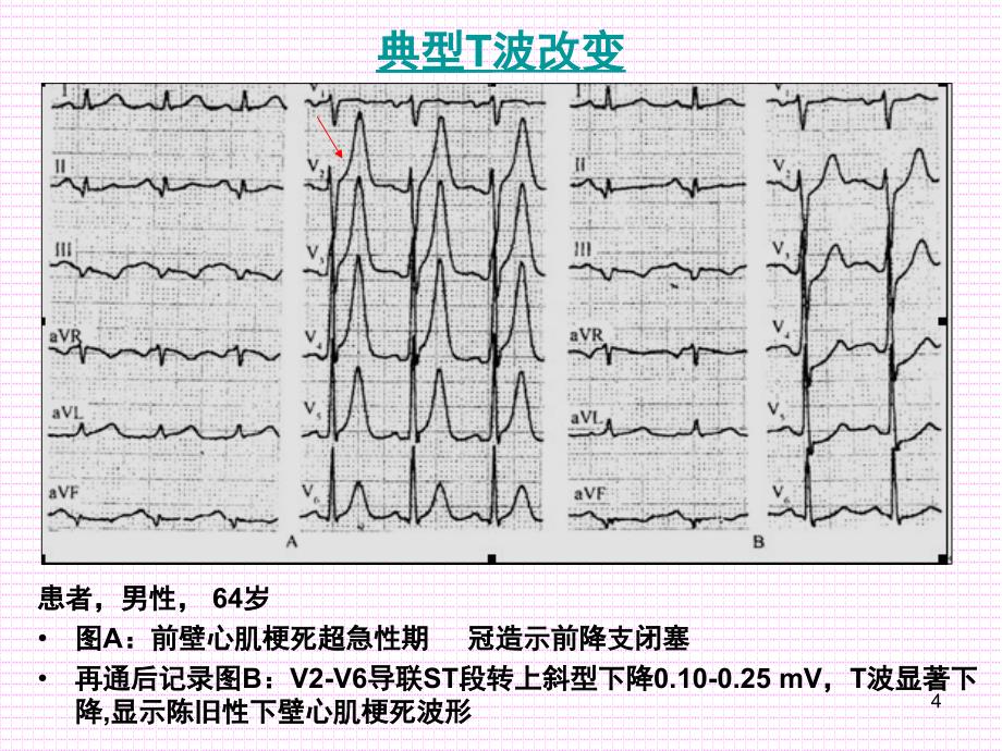 心肌梗死早期心电图表现与鉴别课堂PPT_第4页