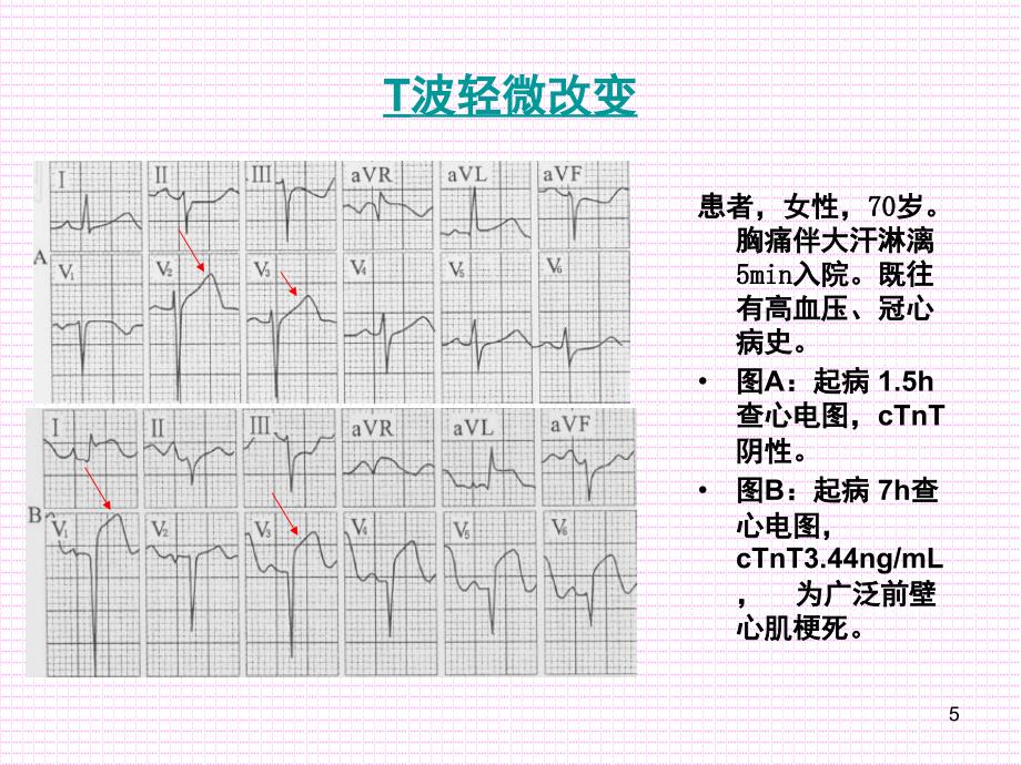 心肌梗死早期心电图表现与鉴别课堂PPT_第5页