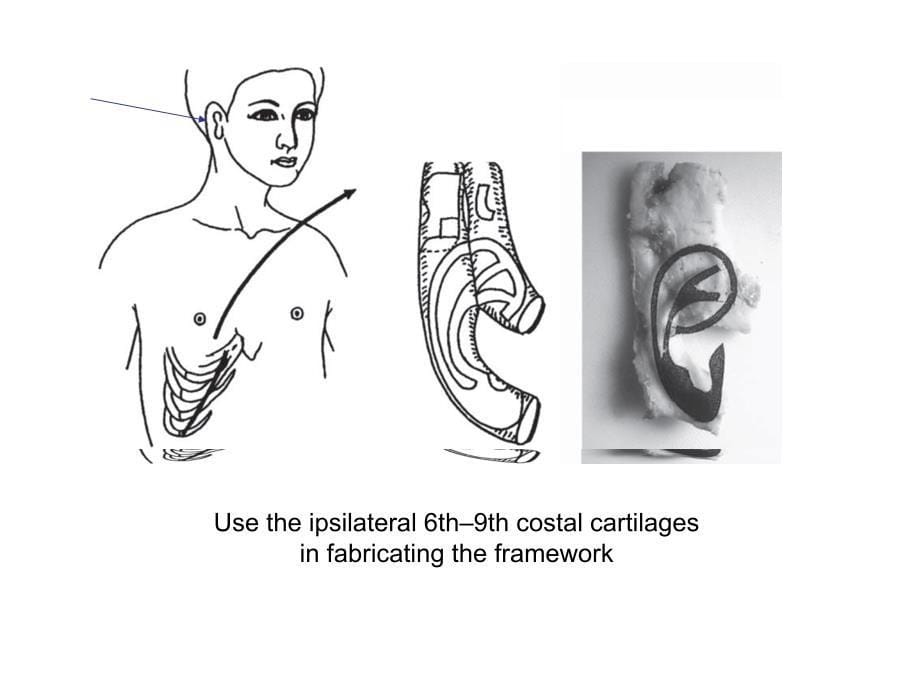 小耳畸形重建_第5页