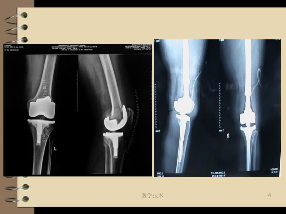 人工全膝关节置换术后护理【医学技术】_第4页