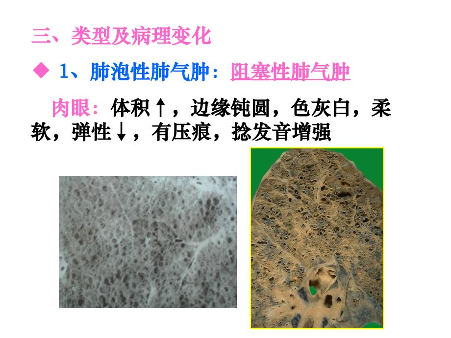 病理学慢性支气管炎、肺气肿、肺心病(下_第3页