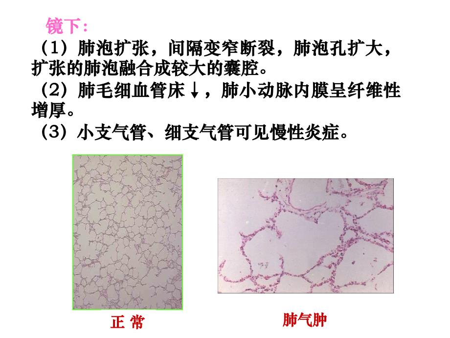 病理学慢性支气管炎、肺气肿、肺心病(下_第4页