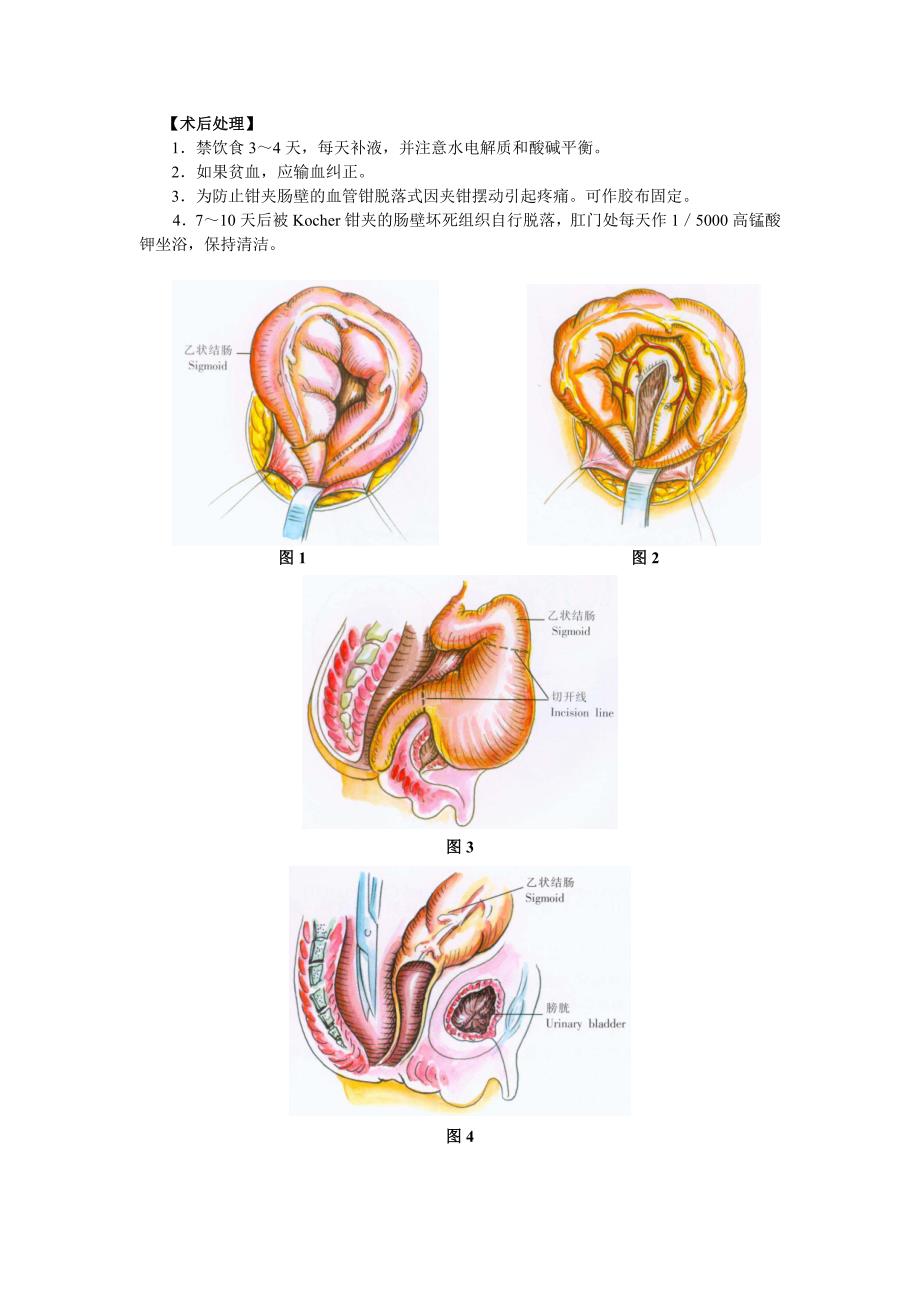 Duhamel结直肠切除和直肠后结肠肛门吻合术.doc_第2页