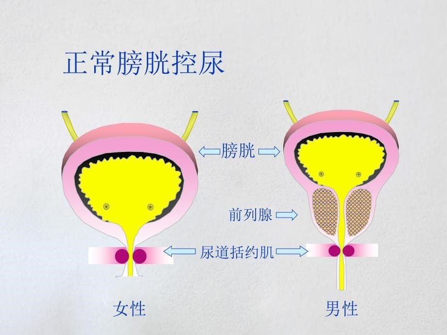 《尿失禁健康讲座su》课件_第5页