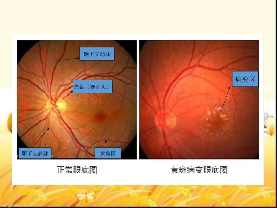 黄斑裂孔的护理PPT课件_第5页